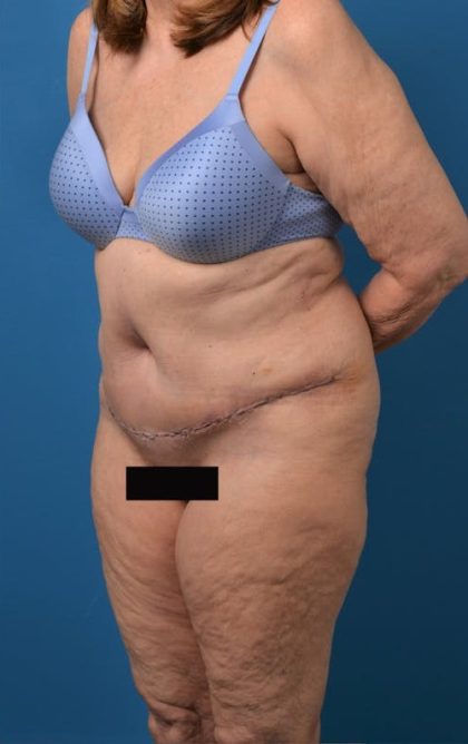 Abdominoplasty Before & After Patient #1274
