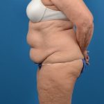Abdominoplasty Before & After Patient #1274