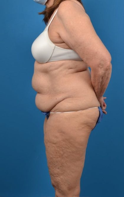 Abdominoplasty Before & After Patient #1274