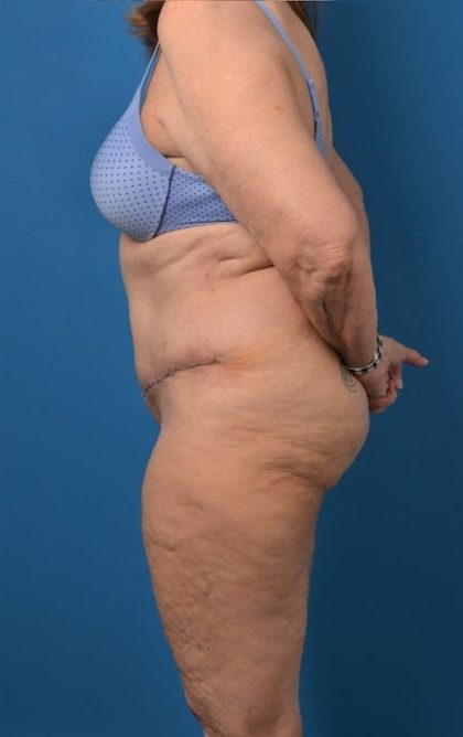Abdominoplasty Before & After Patient #1274