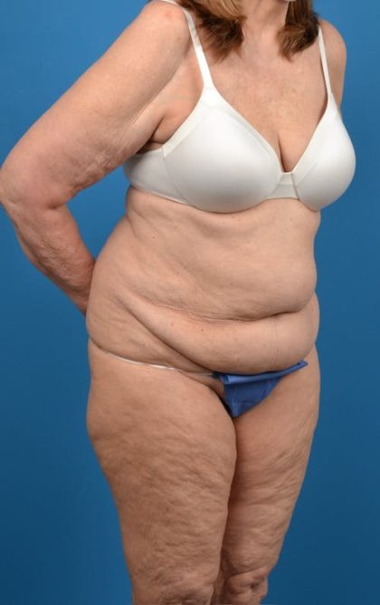 Abdominoplasty Before & After Patient #1274