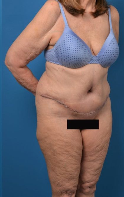 Abdominoplasty Before & After Patient #1274