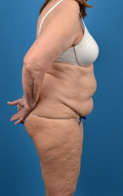 Abdominoplasty Before & After Patient #1274