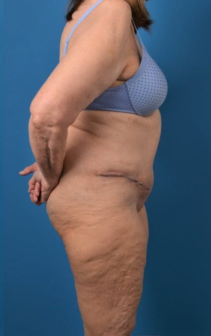 Abdominoplasty Before & After Patient #1274