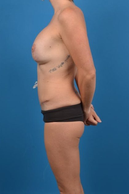 Abdominoplasty Before & After Patient #1272