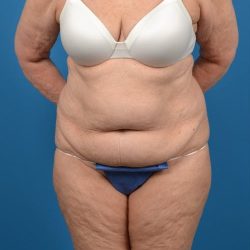 Abdominoplasty Before & After Patient #1287