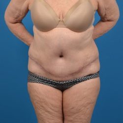 Abdominoplasty Before & After Patient #1287