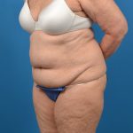 Abdominoplasty Before & After Patient #1287
