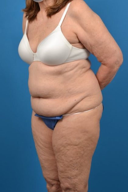 Abdominoplasty Before & After Patient #1287