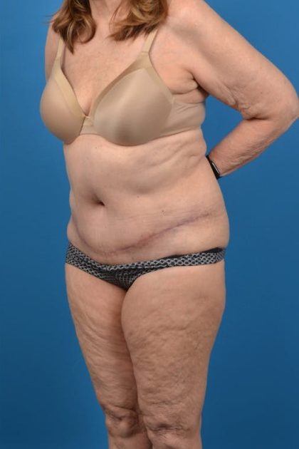 Abdominoplasty Before & After Patient #1287