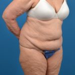 Abdominoplasty Before & After Patient #1287