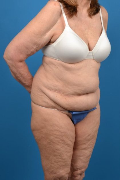 Abdominoplasty Before & After Patient #1287