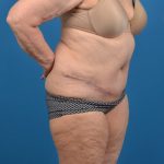 Abdominoplasty Before & After Patient #1287
