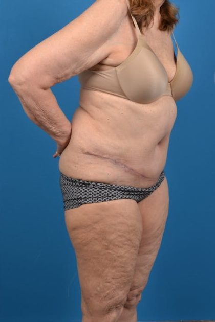 Abdominoplasty Before & After Patient #1287