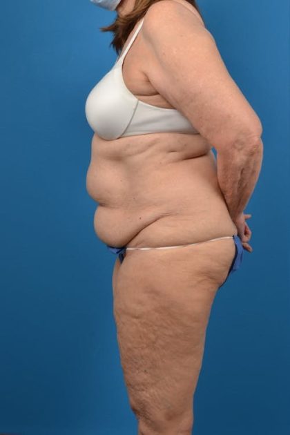 Abdominoplasty Before & After Patient #1287