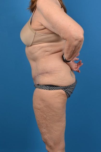 Abdominoplasty Before & After Patient #1287