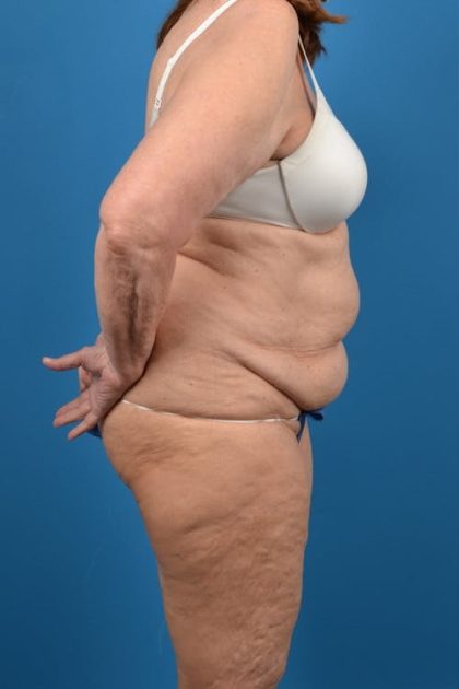 Abdominoplasty Before & After Patient #1287