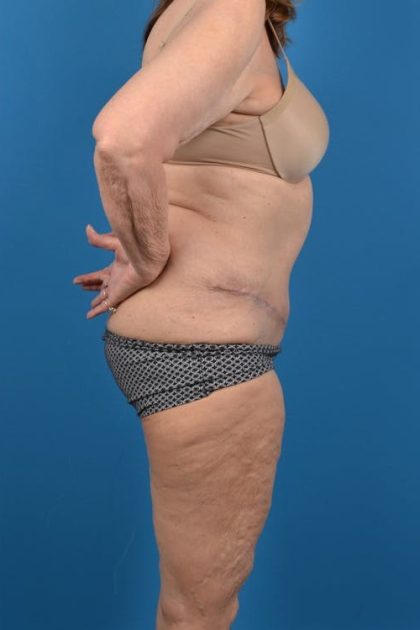 Abdominoplasty Before & After Patient #1287