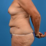 Abdominoplasty Before & After Patient #1286