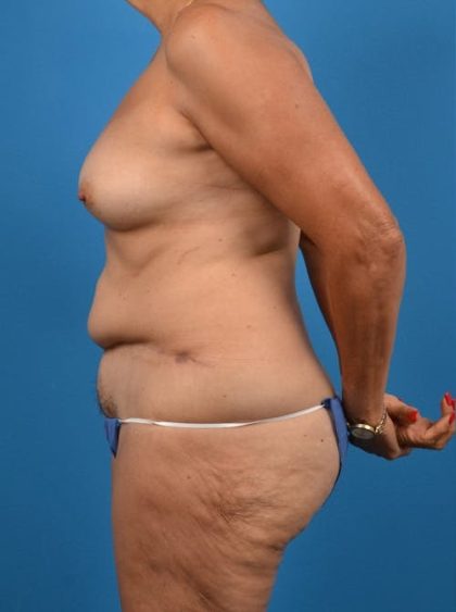 Abdominoplasty Before & After Patient #1286