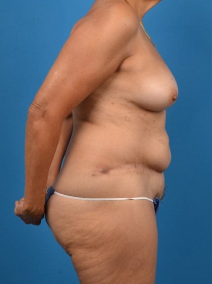 Abdominoplasty Before & After Patient #1286