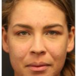 Acne Treatment Before & After Patient #1323
