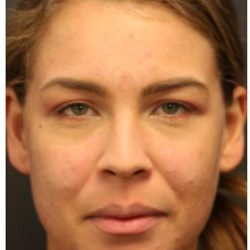 Acne Treatment Before & After Patient #1323