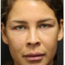 Acne Treatment Before & After Patient #1323