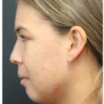 Acne Treatment Before & After Patient #1323