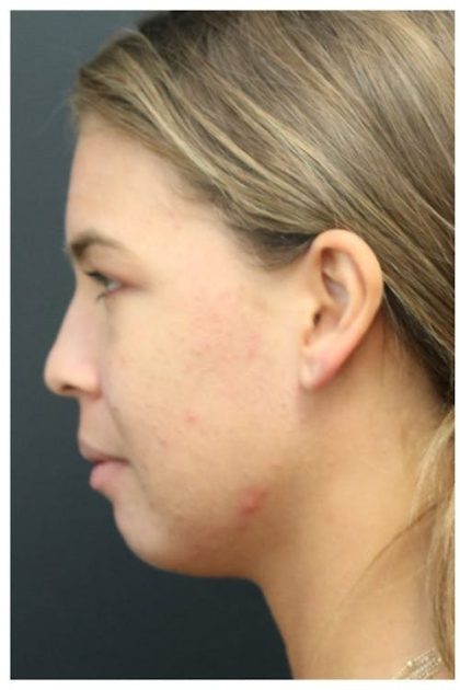 Acne Treatment Before & After Patient #1323