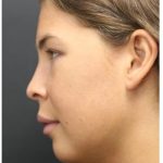 Acne Treatment Before & After Patient #1323