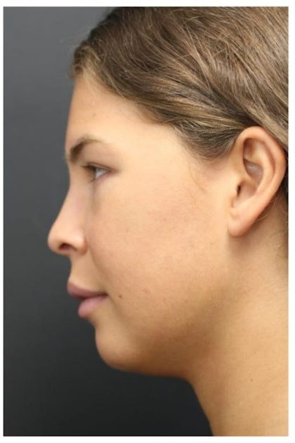 Acne Treatment Before & After Patient #1323