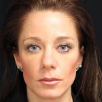 Aesthetic Facial Balancing Before & After Patient #1168