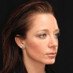 Aesthetic Facial Balancing Before & After Patient #1168