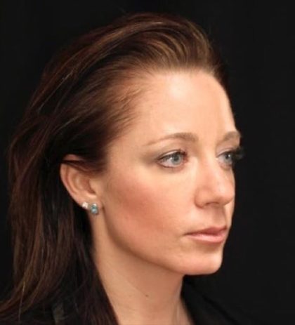 Aesthetic Facial Balancing Before & After Patient #1168