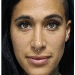 Aesthetic Facial Balancing Before & After Patient #1167