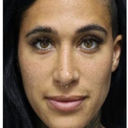 Aesthetic Facial Balancing Before & After Patient #1167