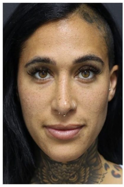 Aesthetic Facial Balancing Before & After Patient #1167