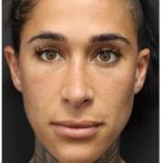 Aesthetic Facial Balancing Before & After Patient #1167