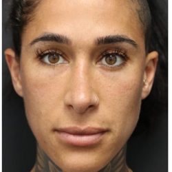 Aesthetic Facial Balancing Before & After Patient #1167