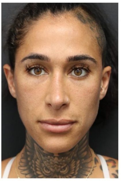 Aesthetic Facial Balancing Before & After Patient #1167