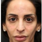 Aesthetic Facial Balancing Before & After Patient #1162