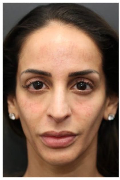 Aesthetic Facial Balancing Before & After Patient #1162
