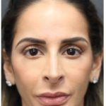 Aesthetic Facial Balancing Before & After Patient #1162