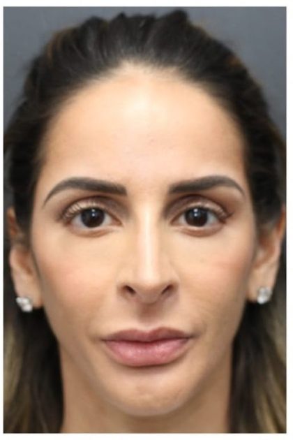 Aesthetic Facial Balancing Before & After Patient #1162