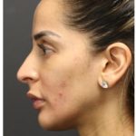 Aesthetic Facial Balancing Before & After Patient #1162