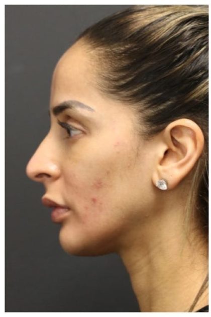 Aesthetic Facial Balancing Before & After Patient #1162