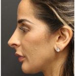 Aesthetic Facial Balancing Before & After Patient #1162