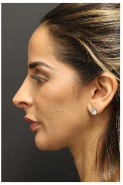 Aesthetic Facial Balancing Before & After Patient #1162