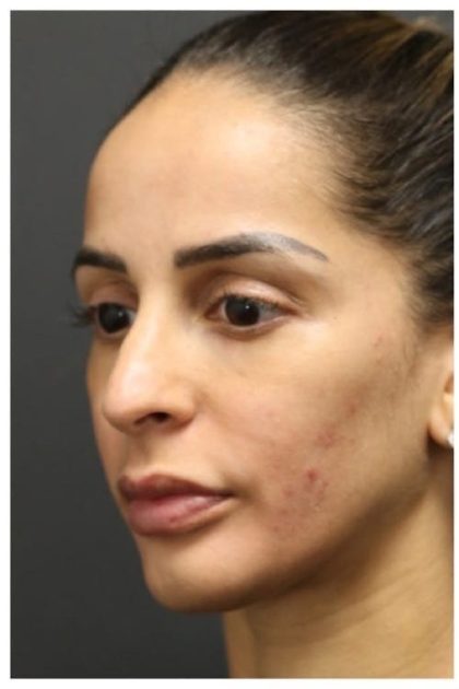 Aesthetic Facial Balancing Before & After Patient #1162